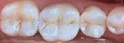 Zhne mit recht zahnfarbener Kunststofffllung