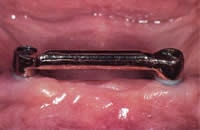2 Implantate mit Steg verbunden