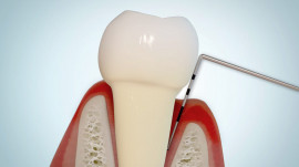 Modell eines einzelnen Zahns